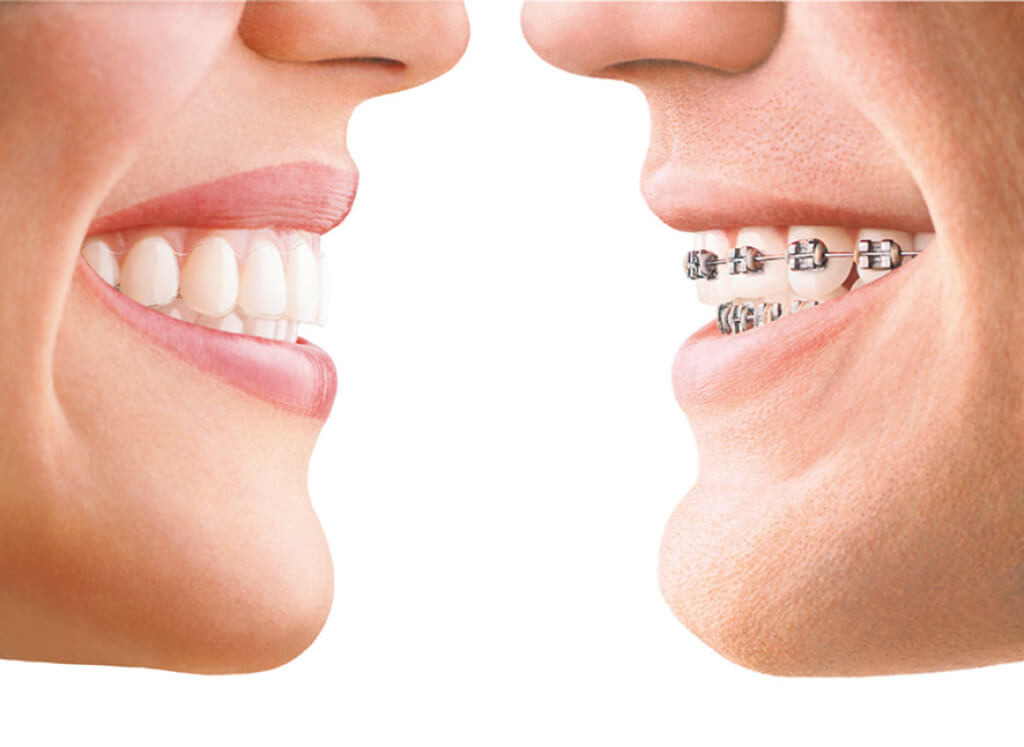 Things That Make Invisalign Better than Other Treatments